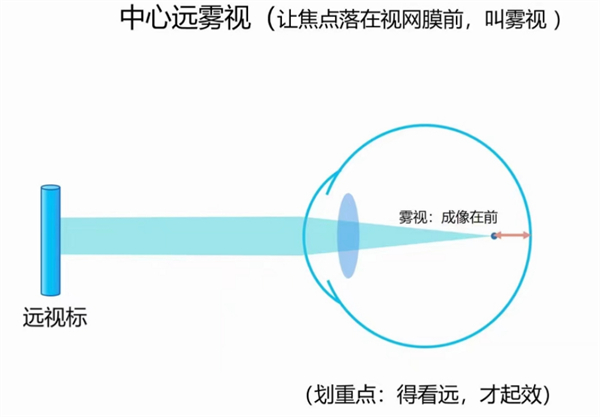 离焦眼镜治疗近视原理图解