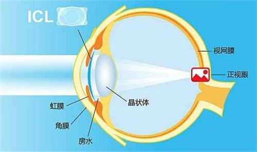 合肥icl手术哪家医院好？合肥做ICL晶体植入手术比较好的好口碑眼科推荐！