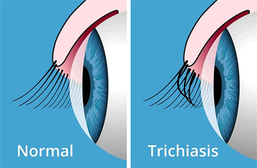 正常睫毛和倒睫