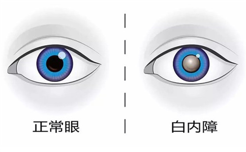 甘肃白内障免费政策2024，符合要求的60岁以上老人可申请免费手术资格！