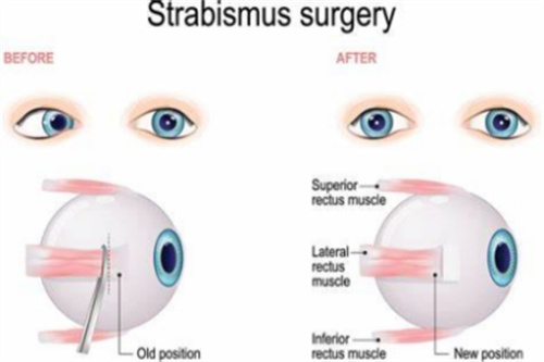 斜视眼球状况