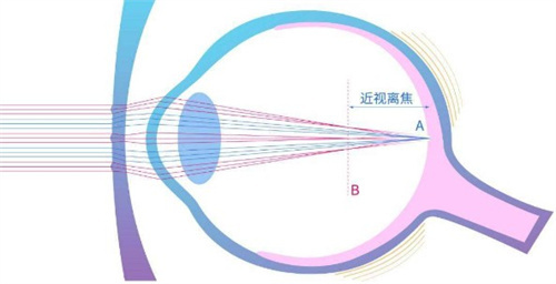 离焦镜片原理