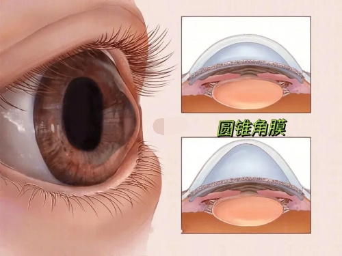 圆锥角膜的角膜状态 圆锥角膜的角膜状态