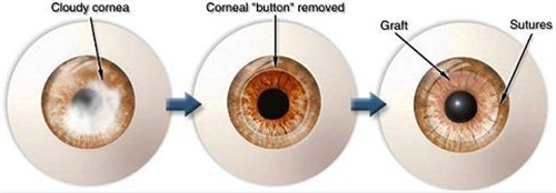 角膜移植手术过程