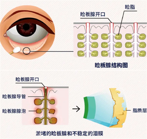 睑板腺疏通过程