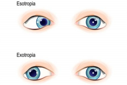 爱尔眼科医院2024年斜视手术价格表:内斜视手术5000元起外斜视手术7000元起
