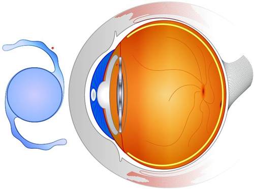 爱博诺德人工晶体和爱尔康怎么选?通过对比两者区别为你解答要如何选择