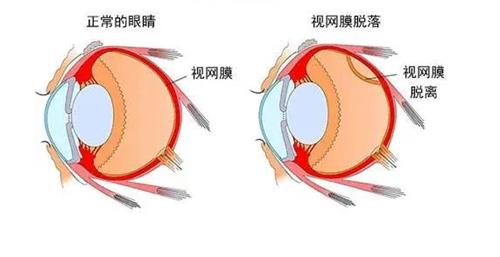 视网膜脱落的眼睛和正常眼睛的对比