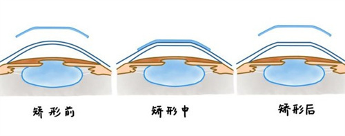 角膜塑形镜矫正原理