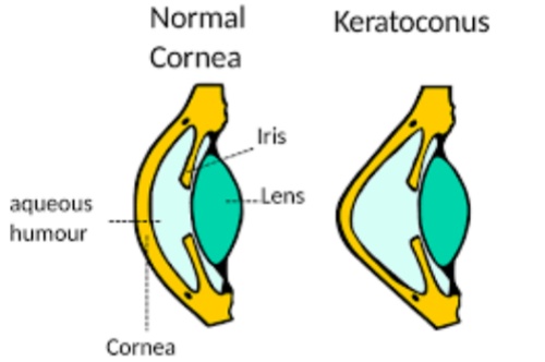 圆锥角膜对比图