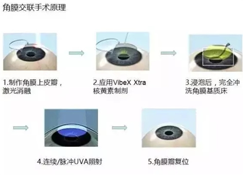 角膜交联手术原理