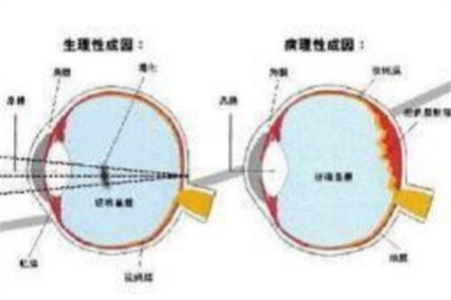不同原因飞蚊症对比