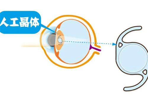 evoicl晶体植入手术认证医生怎么查？国内icl医生资质查询途径