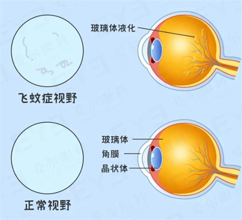 飞蚊症示意图