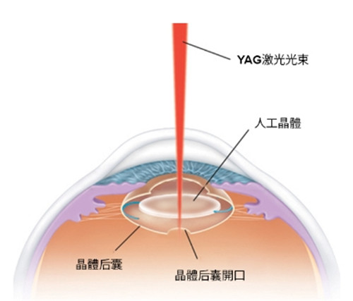 激光治疗细节图.jpg