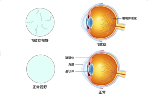 飞蚊症视野和正常视野对比图