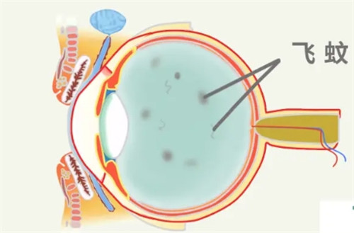 飞蚊症眼部照片