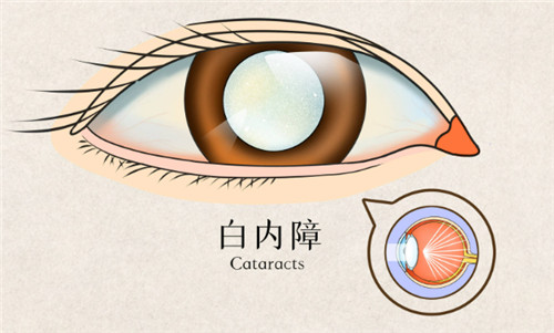 免费的白内障手术有风险吗？白内障免费政策是正规政策所有手术也是正规手术，几乎不会有什么风险！