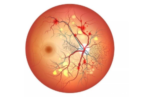 视网膜色素变性概念图