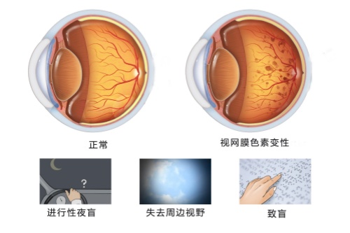 视网膜色素变性症状图