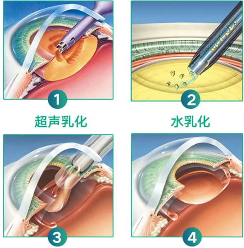 超声乳化白内障手术过程