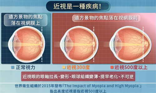 近视激光手术价格一览表：全飞秒、半飞秒、全激光、ICL晶体植入价格