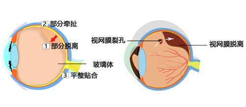 视网膜激光手术多少钱？市场价格1000-2000左右是均价！