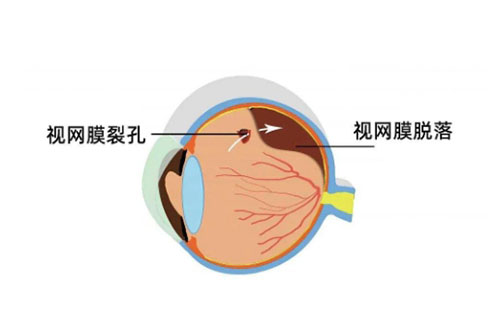 视网膜脱落卡通图片展示