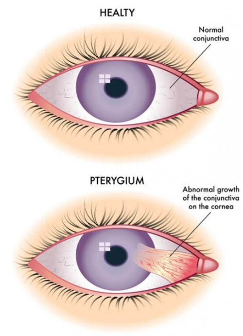 正常眼睛和翼状胬肉眼睛