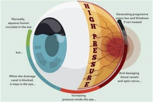 青光眼症状图片