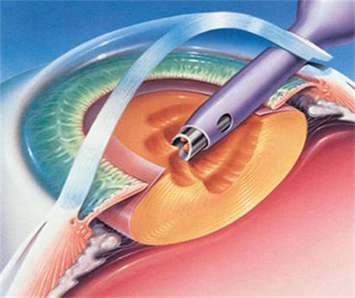 白内障囊外摘除术图片