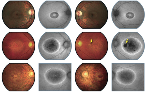 视网膜色素变性的不同程度图解