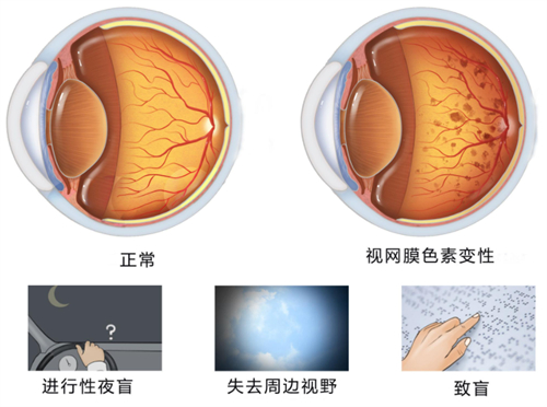 爱尔眼科视网膜色素变性怎么治疗?视觉假体植入,电磁脉冲穴位治疗,镜片矫正均是优选方式!