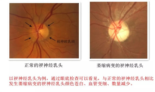 请问一只眼睛视神经萎缩会影响另一只眼睛吗？可以治疗吗？