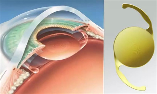 三焦晶体植入一只眼多少钱？单只三焦晶体市场均价在1.5-2.5万元左右！