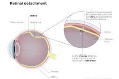 视网膜脱落眼球状况