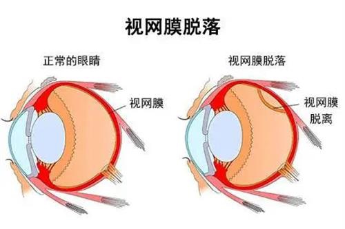 视网膜脱落和正常眼示意图