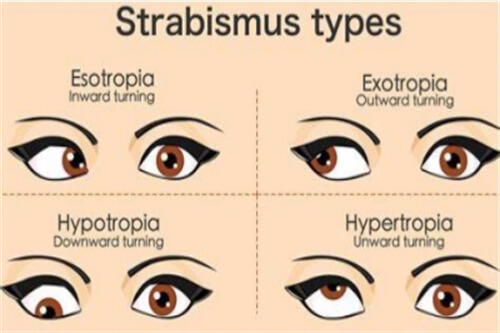上海做斜视手术的费用多少钱？内斜视矫正4000起，外斜视矫正5000起！