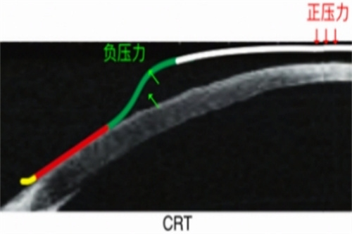 CRT角膜塑形镜力的示意图
