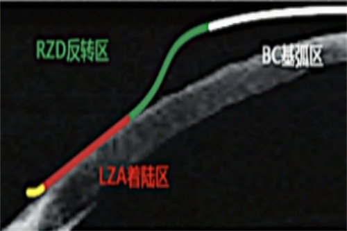 CRT角膜塑形镜作用示意图