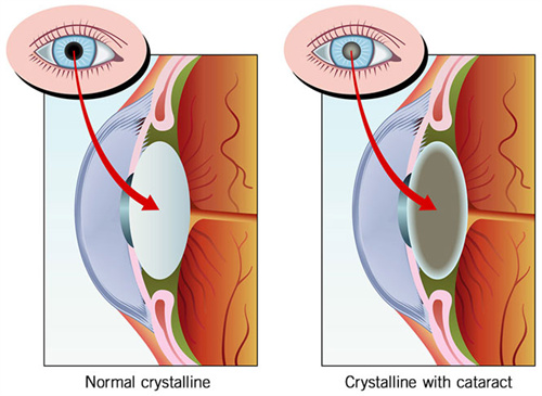 晶体置换手术前后对比