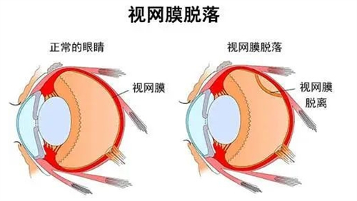 视网膜脱离和正常眼睛的区别