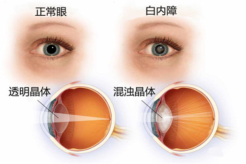 白内障与正常眼睛对比图