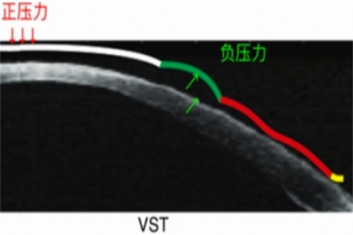 VST角膜塑形镜力的示意图