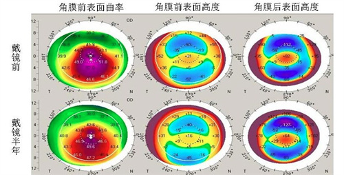 角膜检查