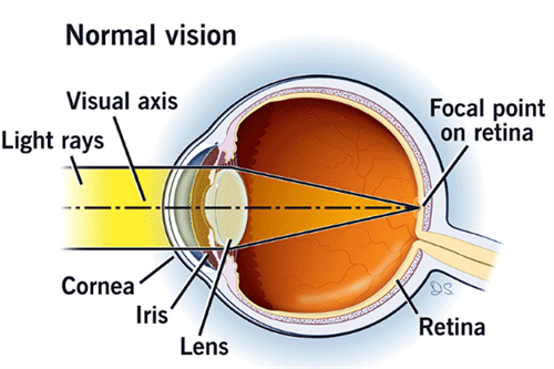 近视视光的样子图解