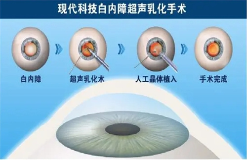 白内障手术一只眼睛多少钱？单焦晶体2000起，双焦晶体3500起，双焦晶体14000起！