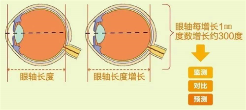 眼轴长度与近视