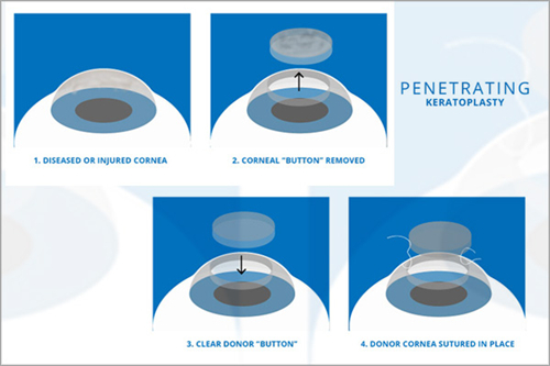 角膜移植过程图示