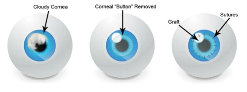 角膜移植图示
